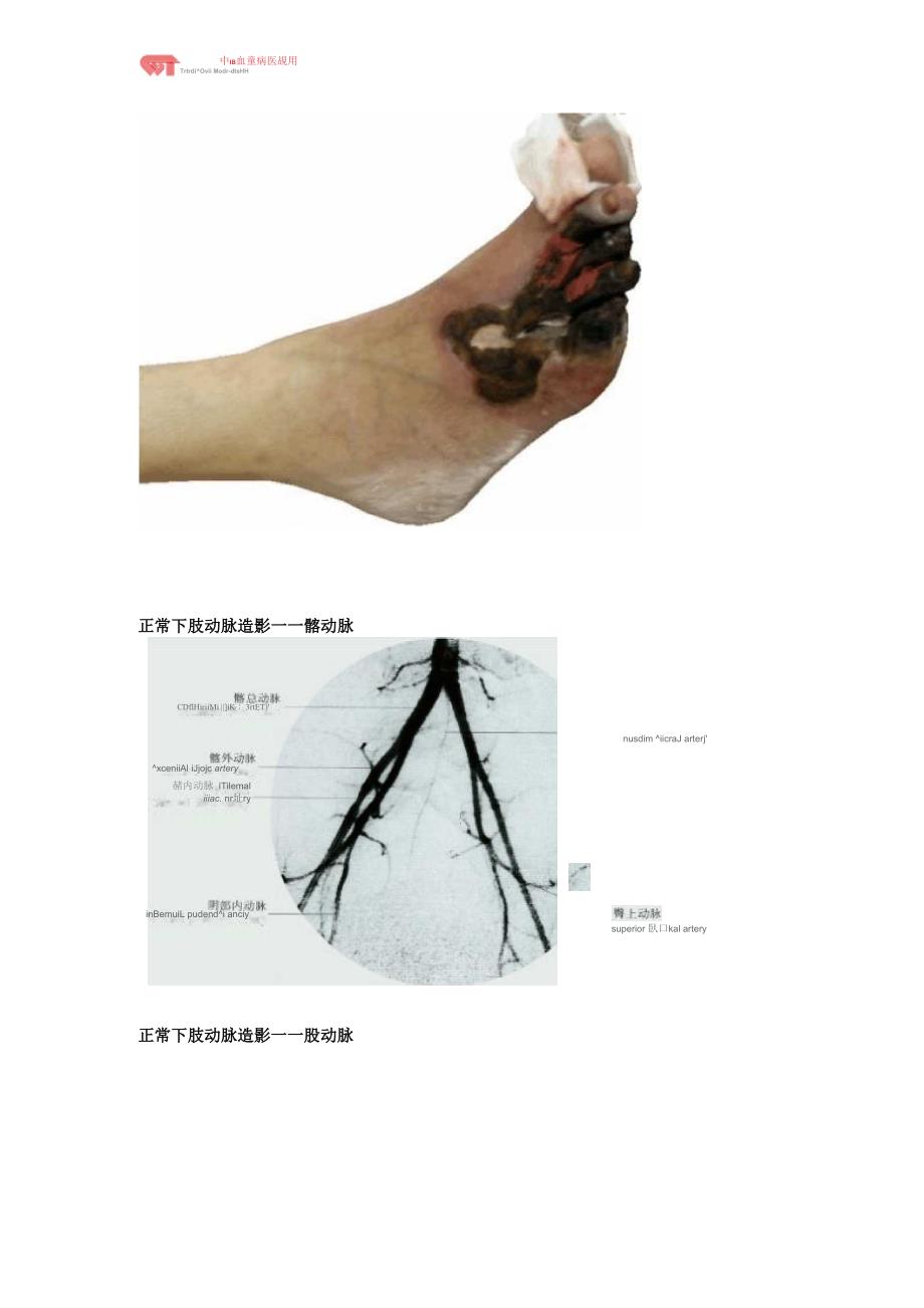 下肢动脉硬化闭塞症的诊治_第2页