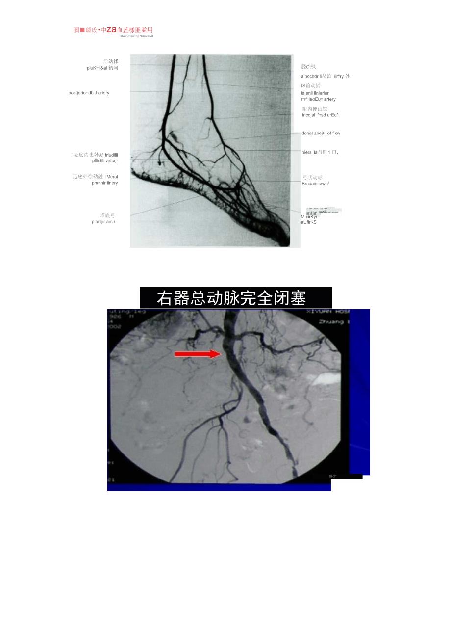 下肢动脉硬化闭塞症的诊治_第4页