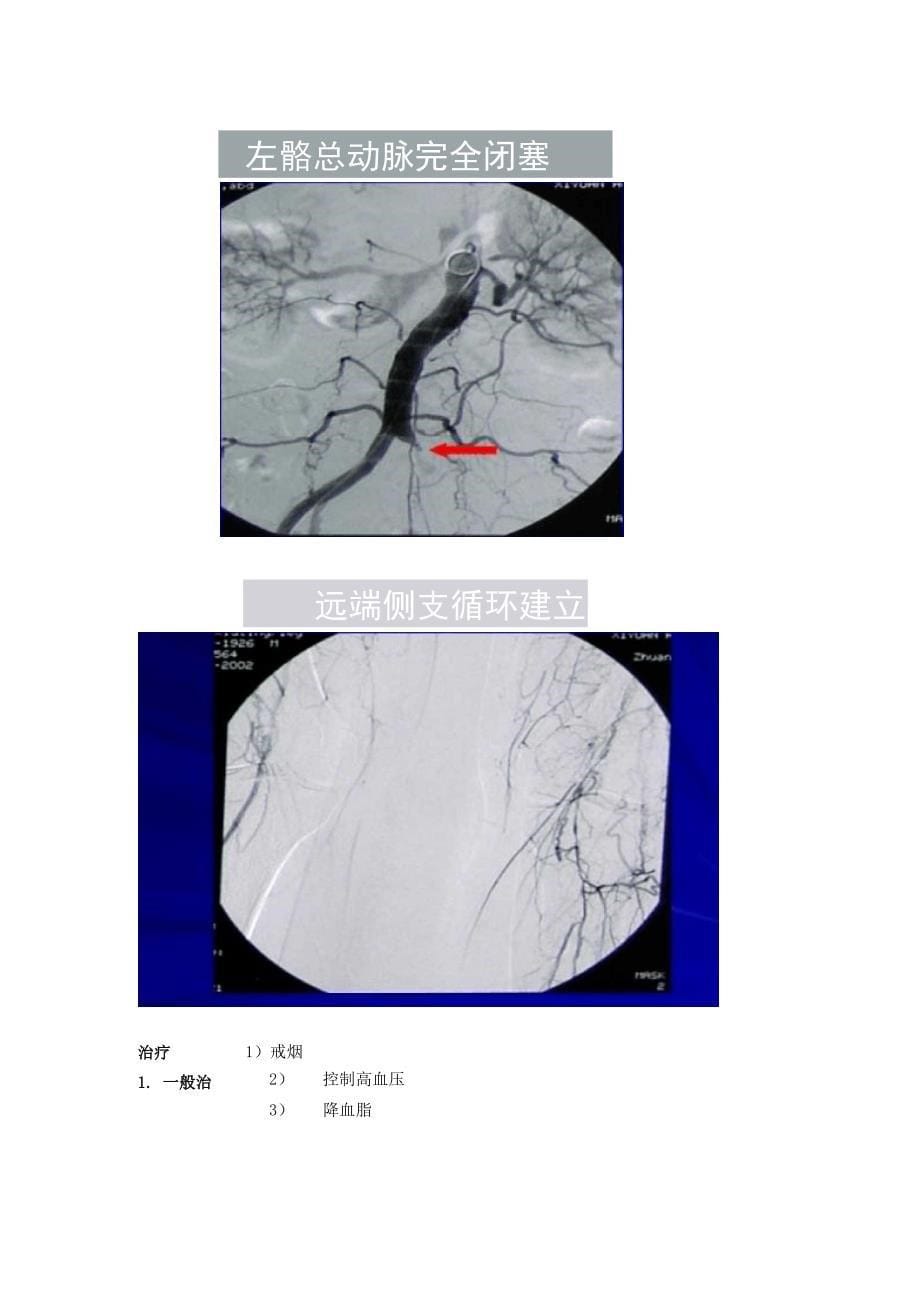 下肢动脉硬化闭塞症的诊治_第5页