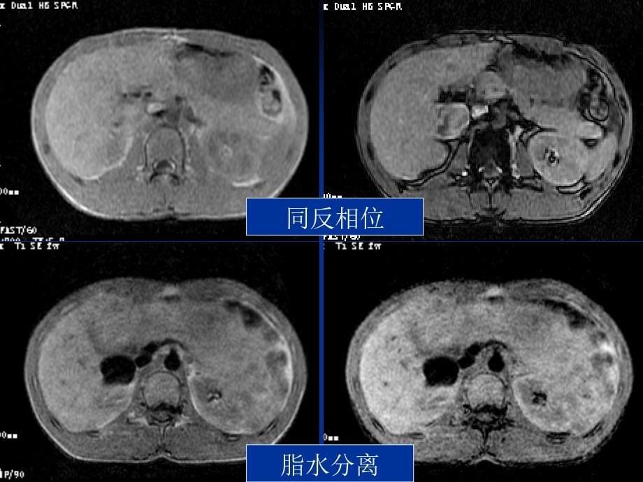 最新：肝脏局灶性结节增生的影像学表现ppt课件文档资料_第5页