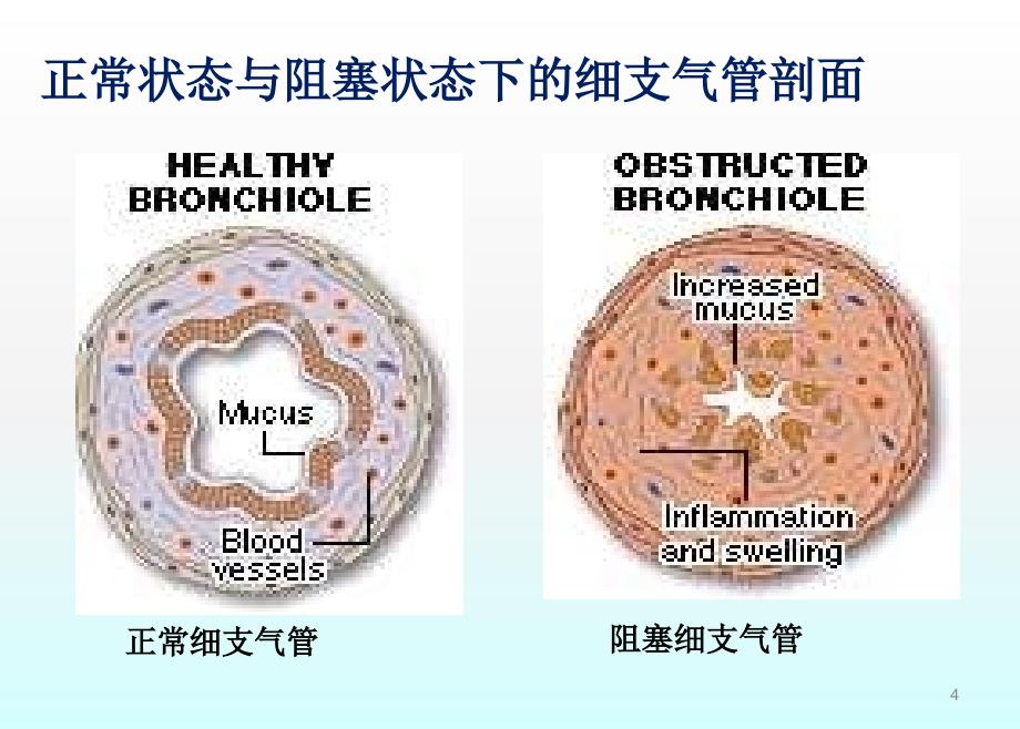 哮喘健康教育支气管哮喘防治ppt课件_第4页