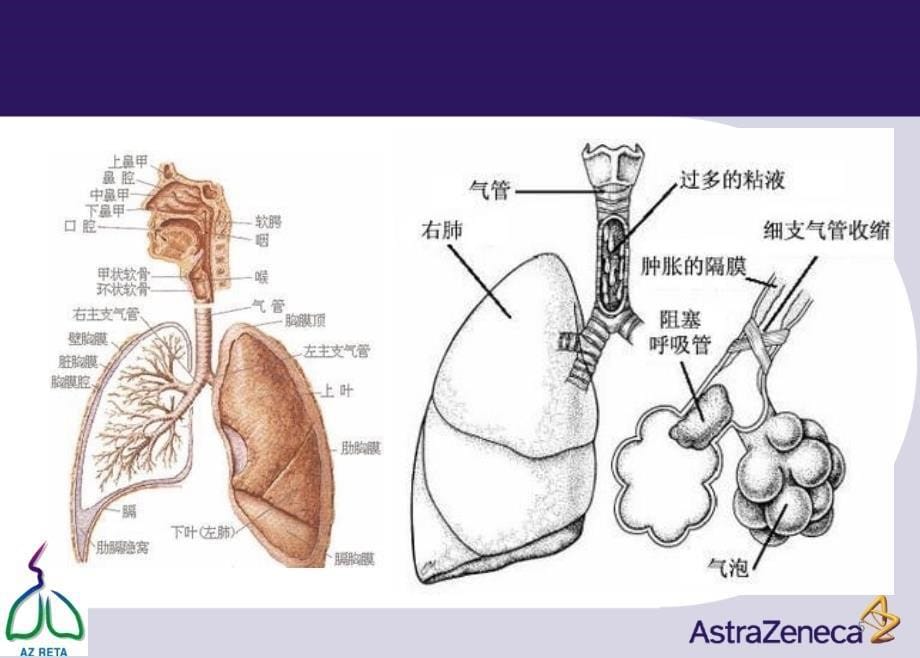 哮喘健康教育支气管哮喘防治ppt课件_第5页