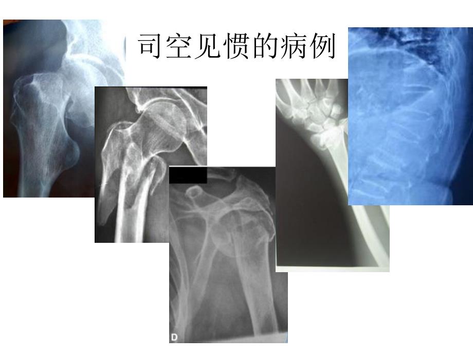 脆性骨折的医学处理_第2页