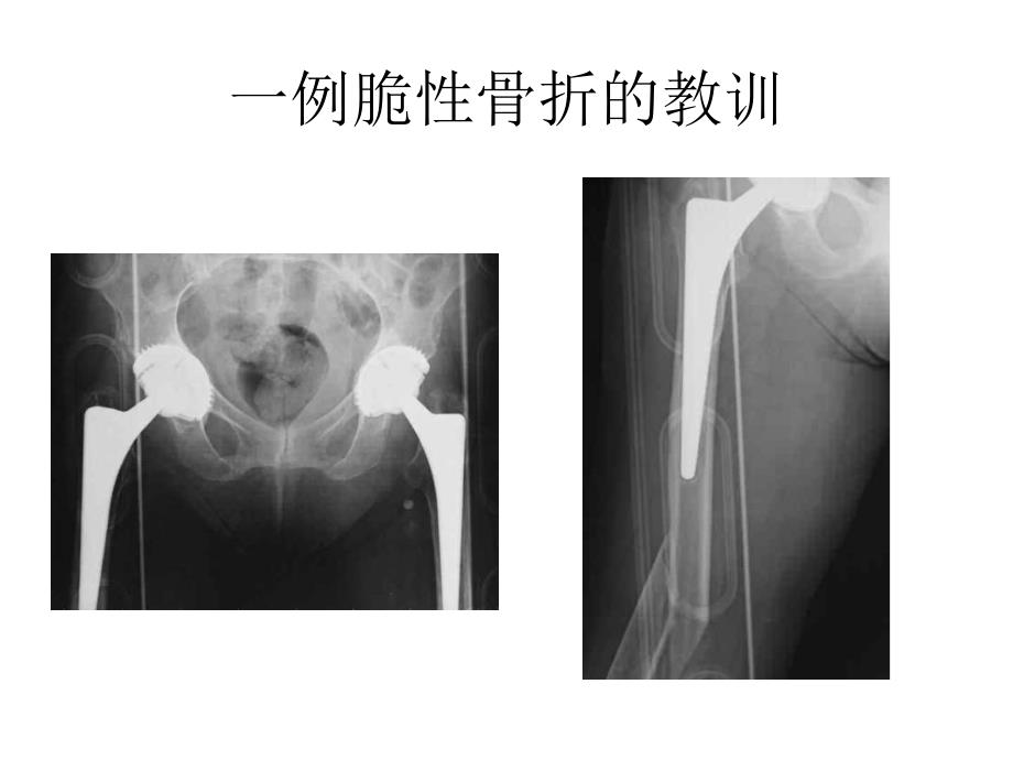 脆性骨折的医学处理_第4页