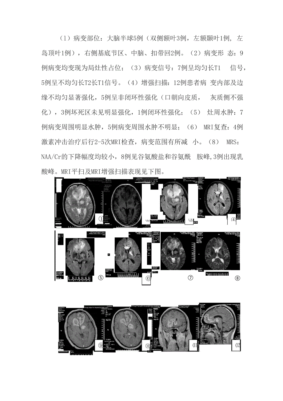 炎性脱髓鞘性假瘤_第4页