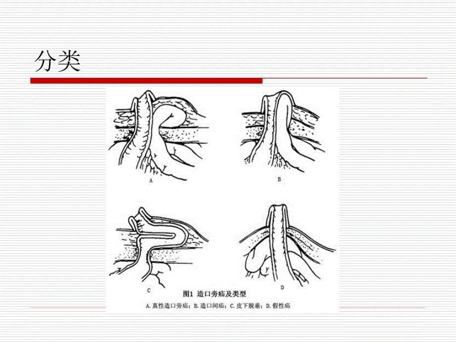 造口旁疝的诊断和治疗_第5页