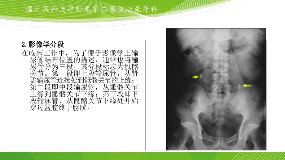 输尿管结石的微创治疗.ppt_第3页