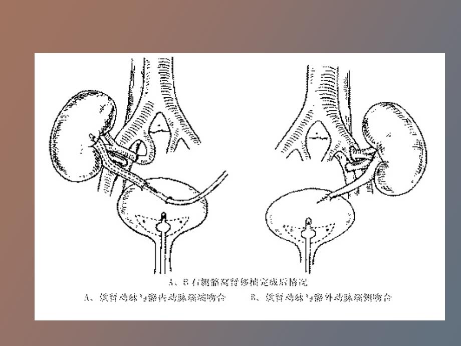 器官移植病人的麻醉_第4页