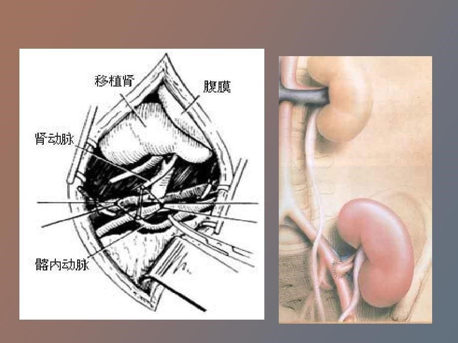 器官移植病人的麻醉_第5页