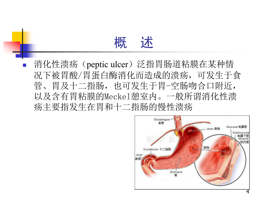 消化性溃疡PPT幻灯片课件_第4页