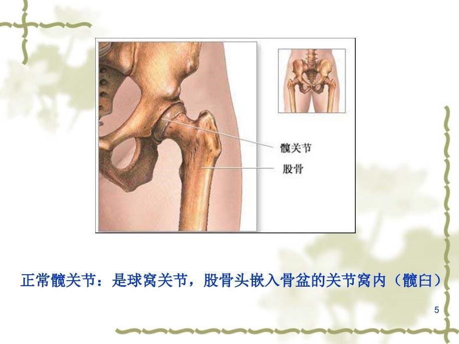 图解髋关节置换术25260_第5页