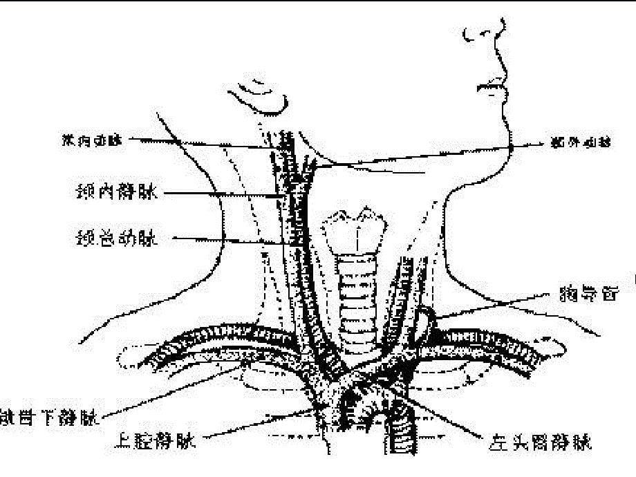 中心静脉穿刺置管通用课件_第5页