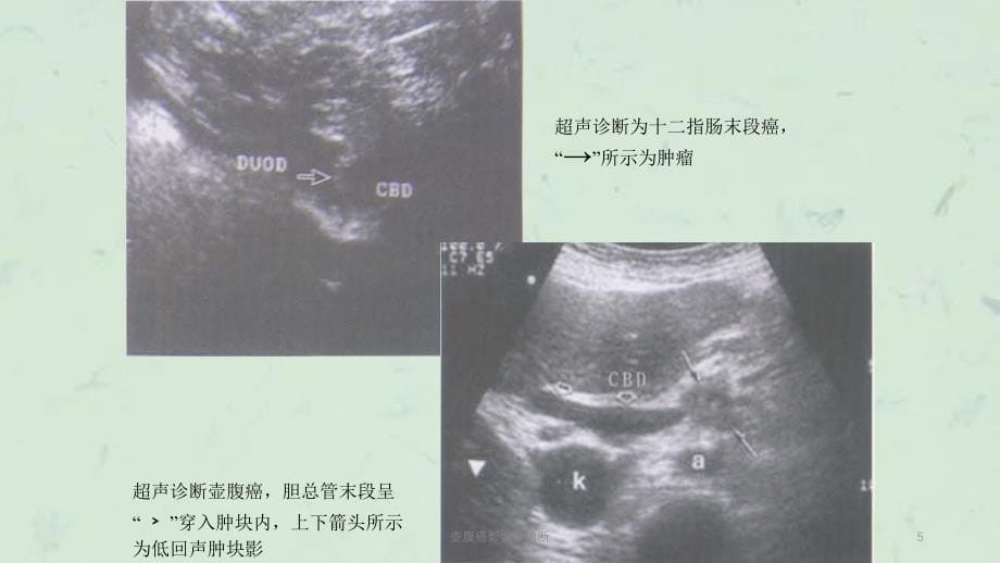 壶腹癌影像学诊断课件_第5页