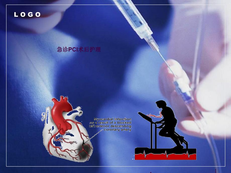 PCI术后护理ppt课件_第1页