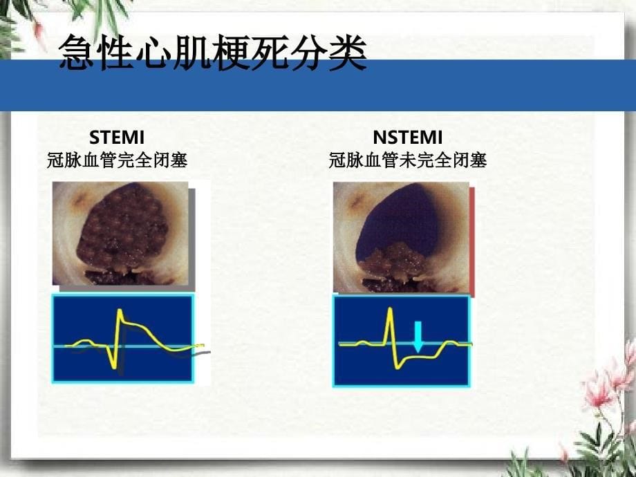 STEMI患者的诊断与鉴别诊断_第5页