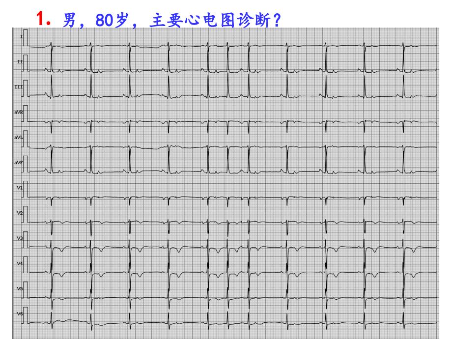 《疑难心电图诊断》PPT课件_第2页