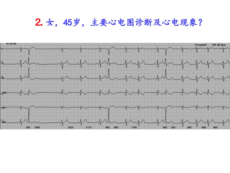 《疑难心电图诊断》PPT课件_第4页