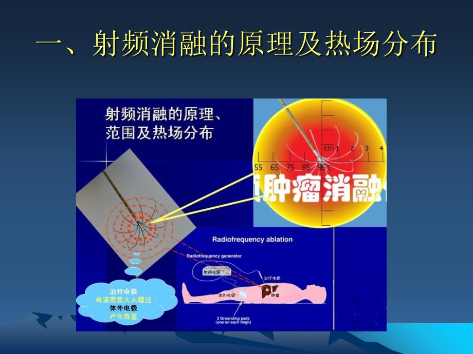 肿瘤射频消融治疗的创新技术_第2页