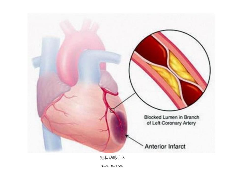 冠状动脉介入课件_第3页