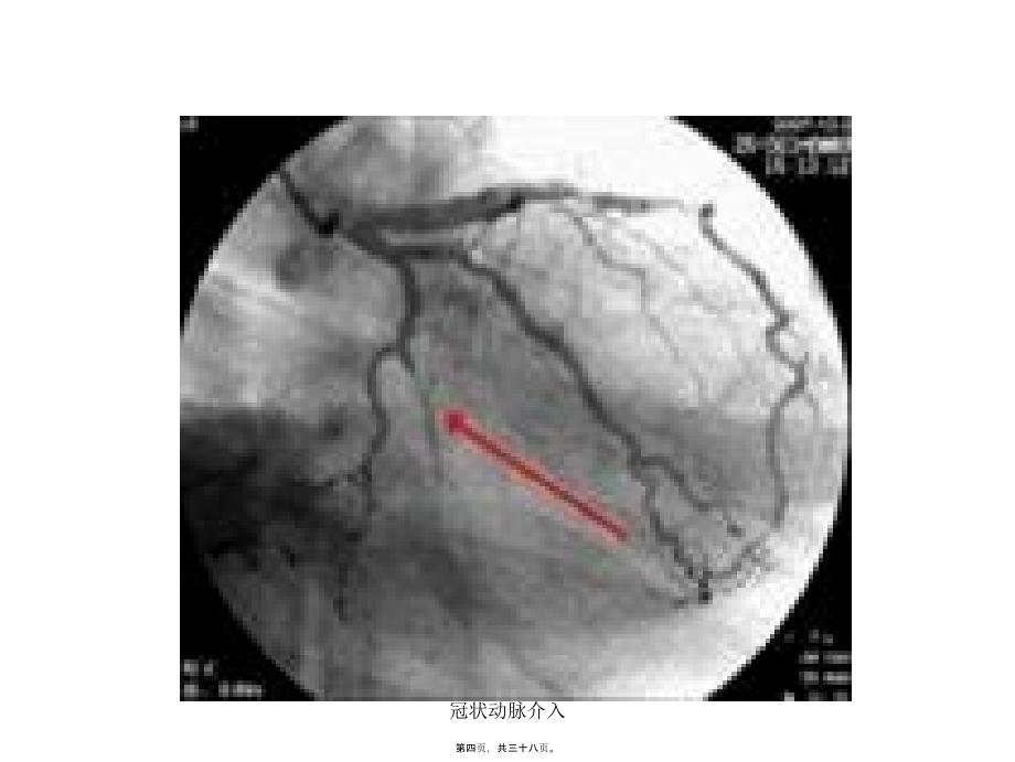 冠状动脉介入课件_第4页