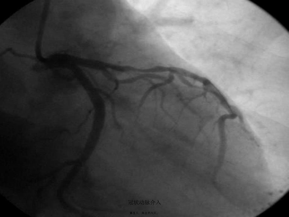 冠状动脉介入课件_第5页