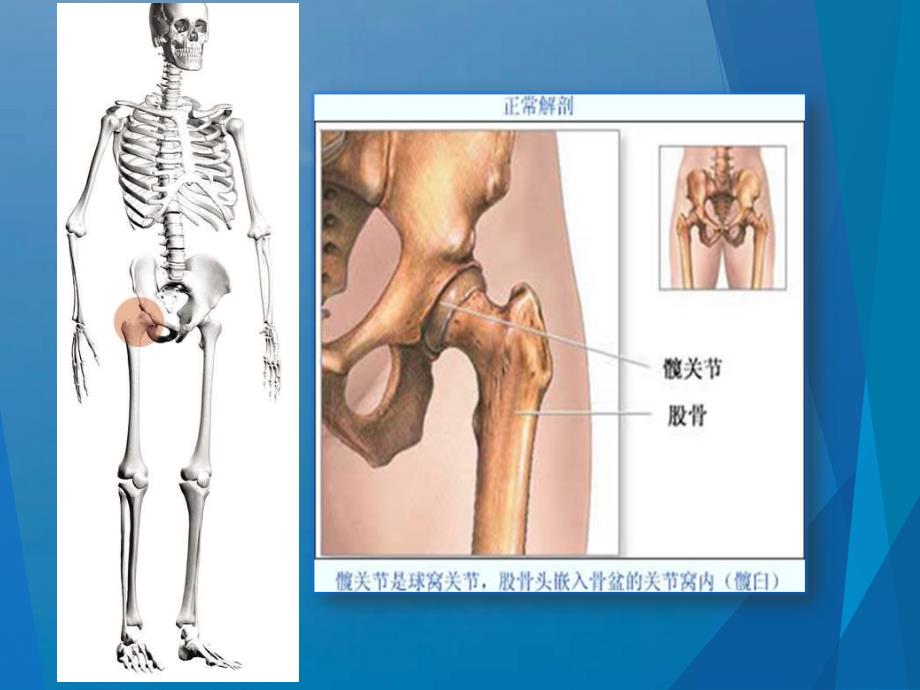 髋关节置换护理实习生讲课ppt课件_第4页