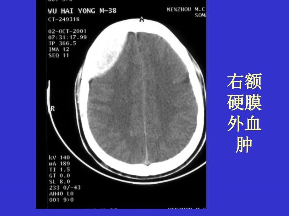 常见疾病的典型CT片阅读课件_第5页