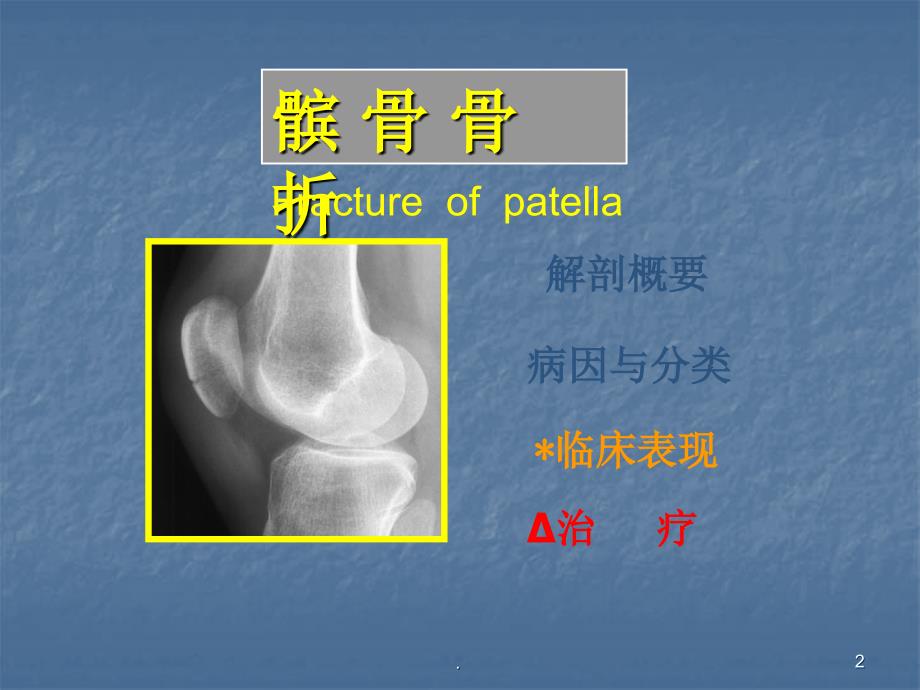 髌骨骨折ppt演示课件_第2页