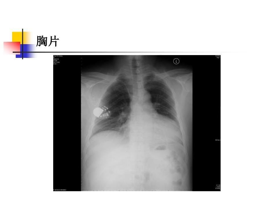 治疗起搏器囊袋感染一例_第5页