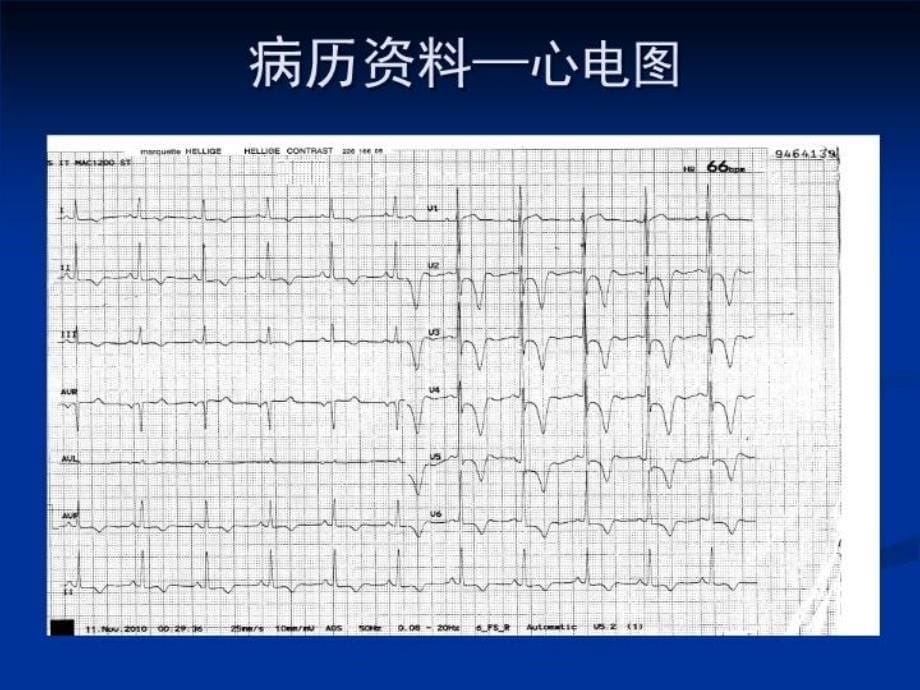 最新心尖肥厚型心肌病PPT课件_第5页