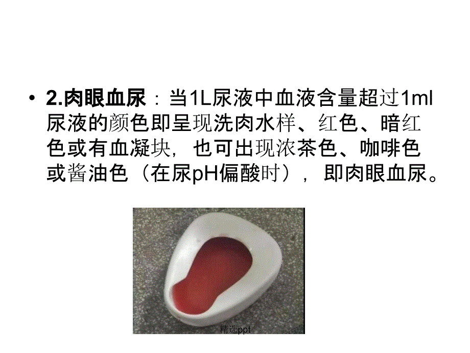 浅谈血尿的临床意义1_第3页