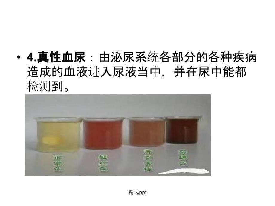 浅谈血尿的临床意义1_第5页