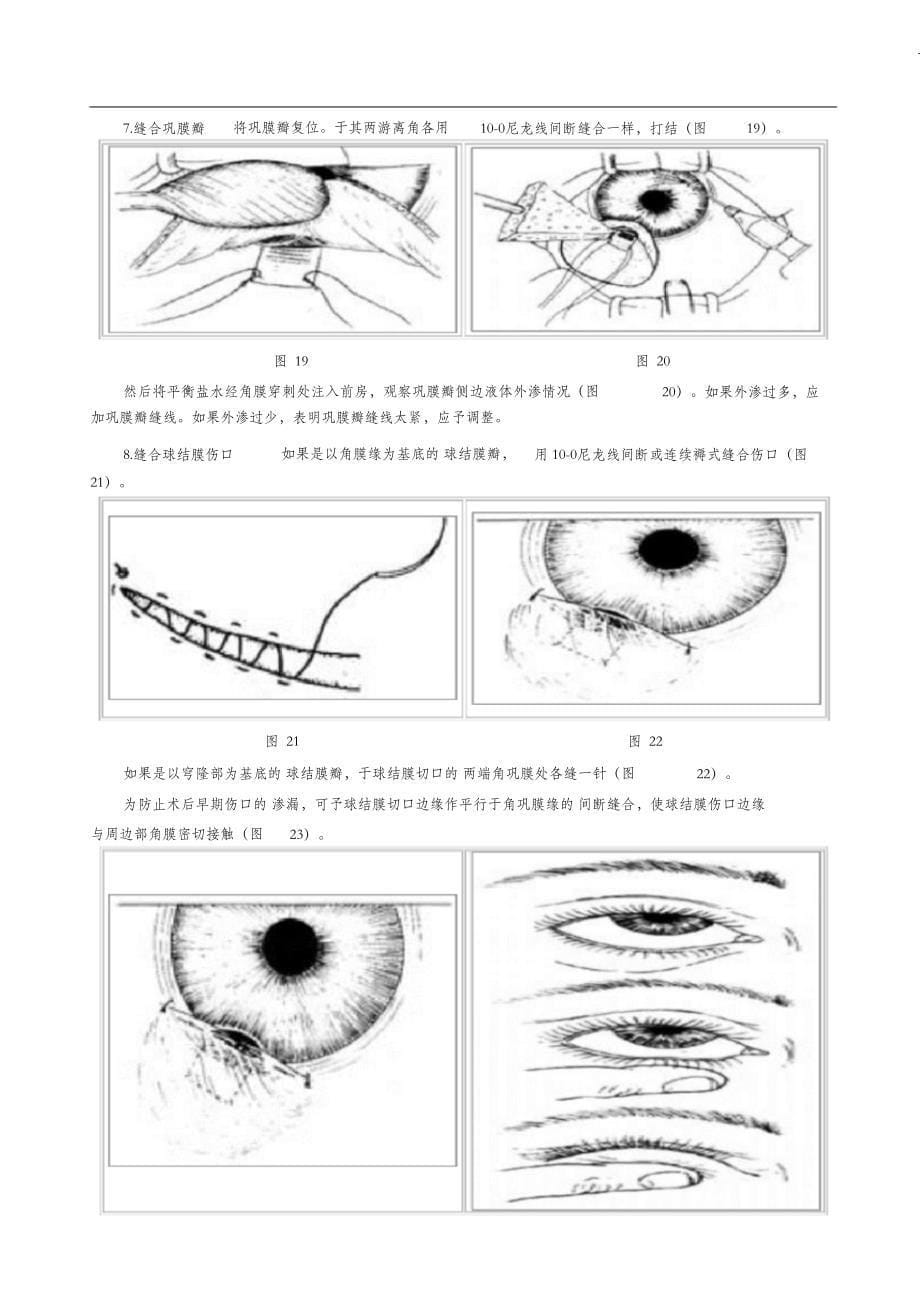 （完整版）小梁切除术_第5页