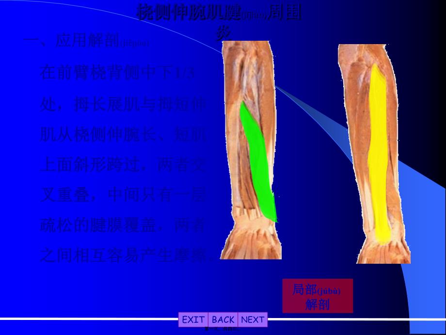 医学专题—桡侧伸腕肌腱周围炎_第1页