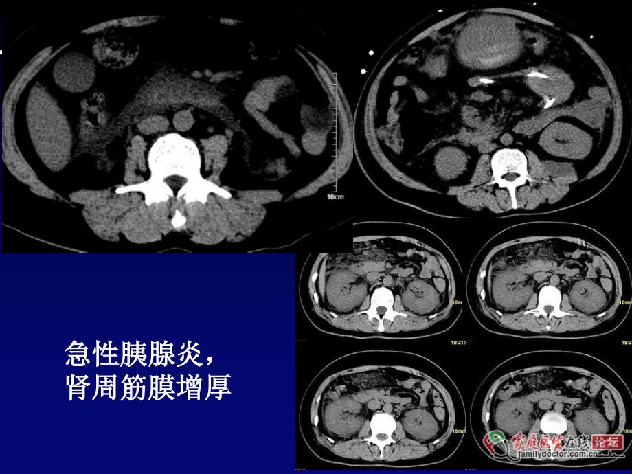 腹膜后间隙解剖及CT诊断PPT课件文档资料_第4页