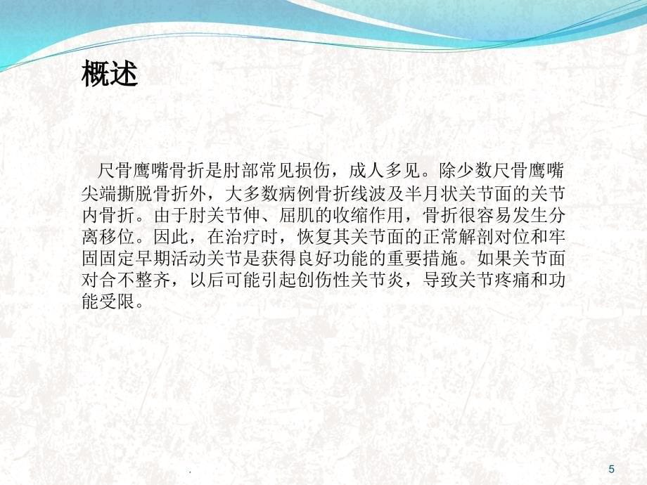 尺骨鹰嘴骨折ppt医学课件_第5页