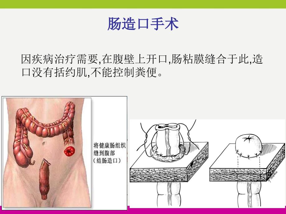 造口护理健康宣教ppt_第3页