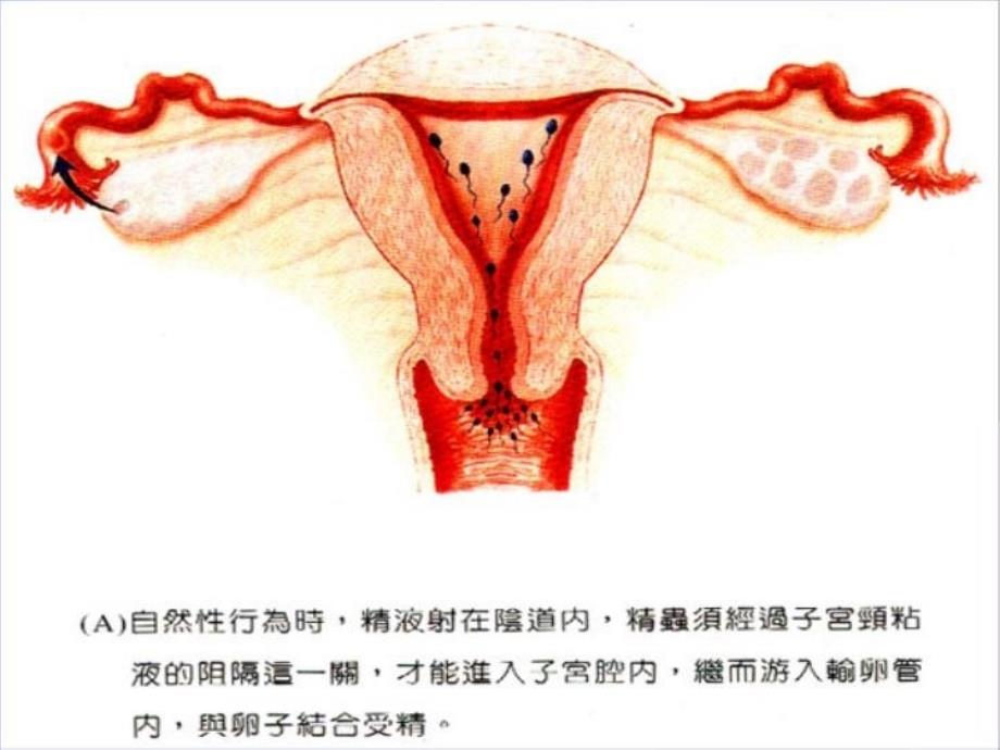 不孕症 课件复习课程_第4页