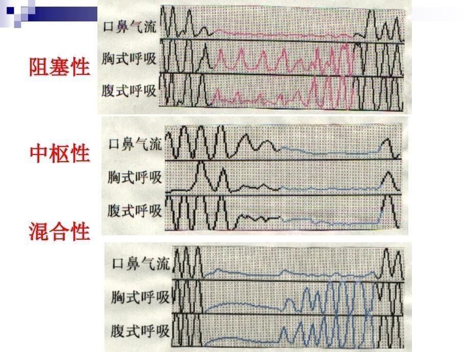 睡眠呼吸暂停低通气综合症_第5页