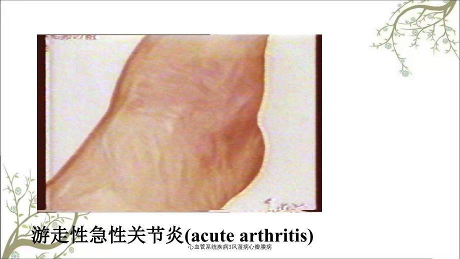 心血管系统疾病3风湿病心瓣膜病_第4页