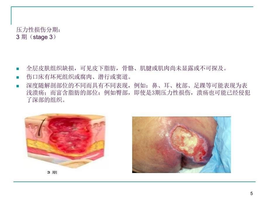 压力性损伤与失禁相关性皮炎ppt课件_第5页