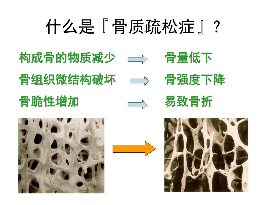 老年人骨质疏松的原因防治_第4页