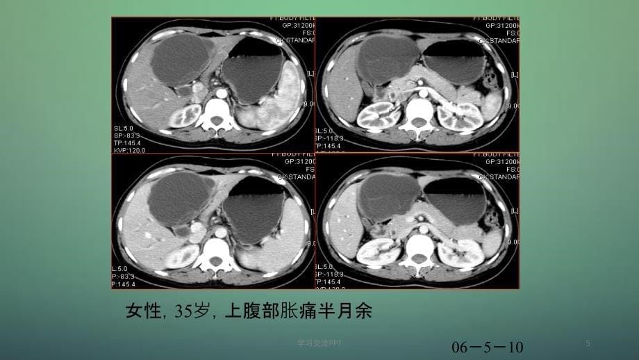 肝脏囊性病变影像鉴别诊断ppt课件_第5页