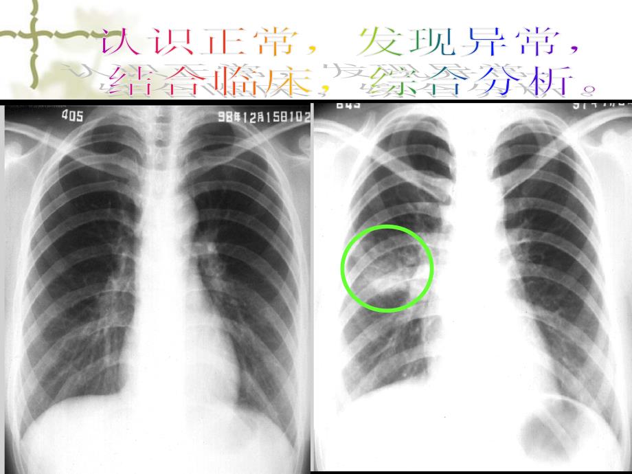 正确阅读胸片_第4页