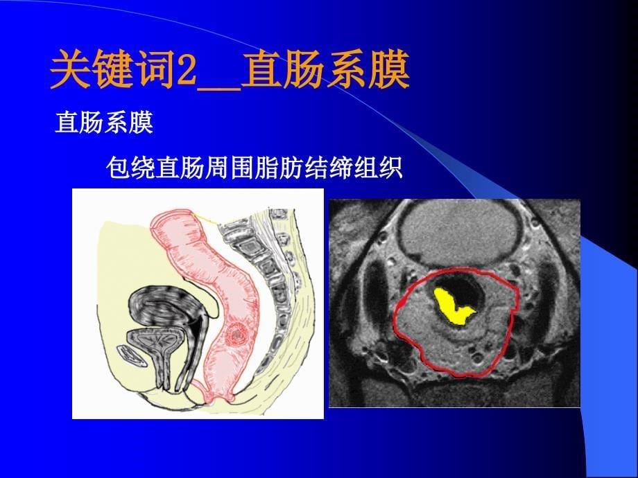 腹腔镜全直肠系膜切除术的实践和探讨.ppt_第5页