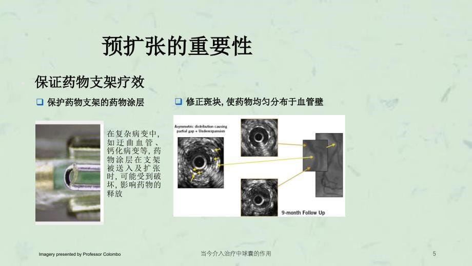 当今介入治疗中球囊的作用课件_第5页