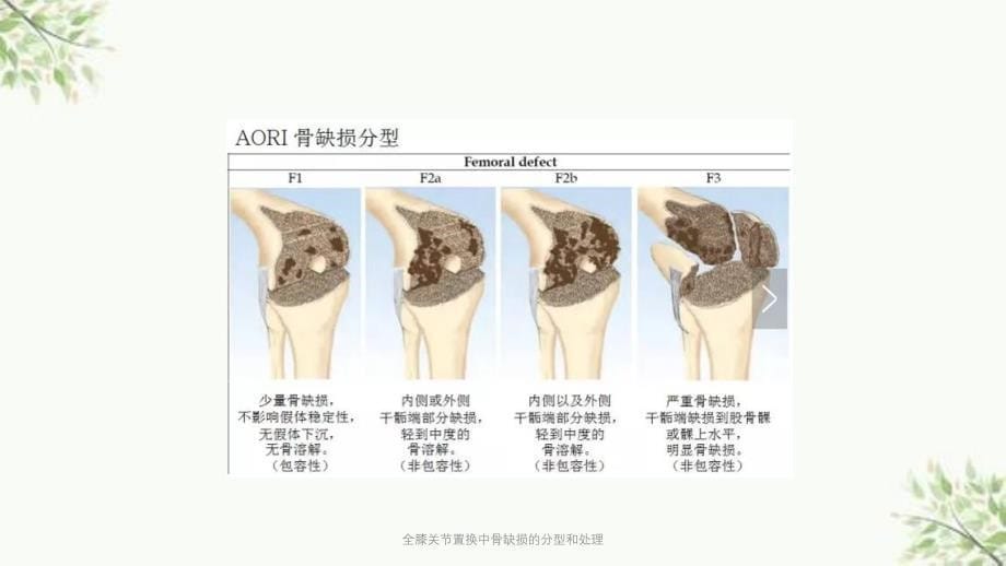 全膝关节置换中骨缺损的分型和处理课件_第5页