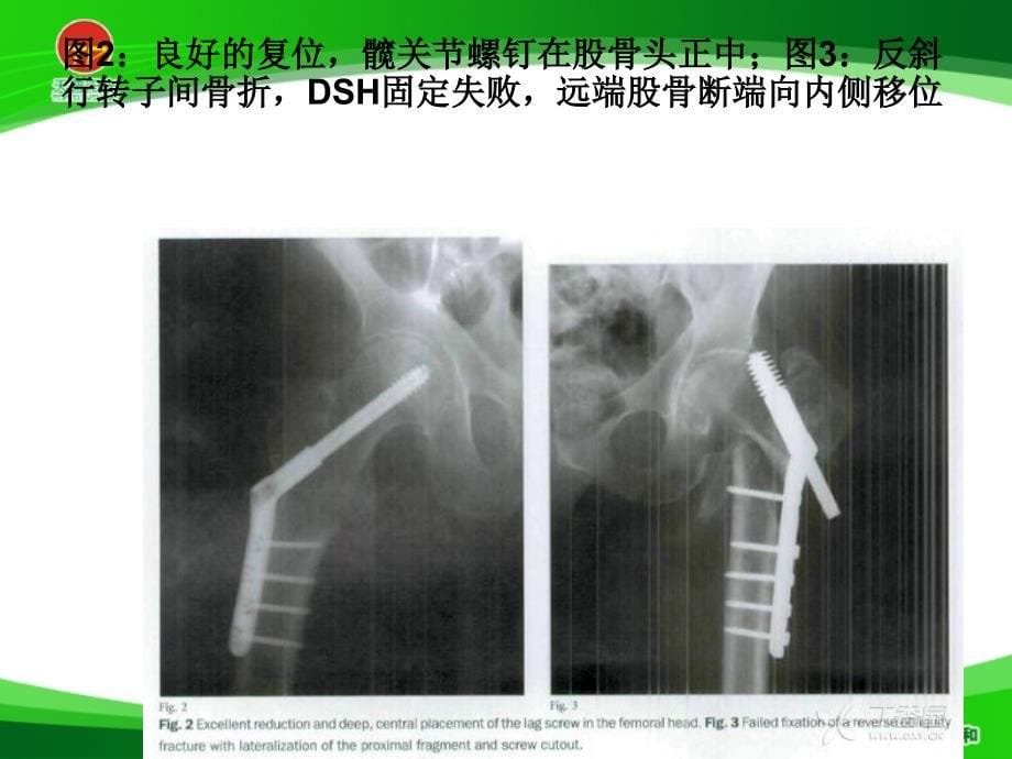 转子间骨折的10个手术技巧_第5页