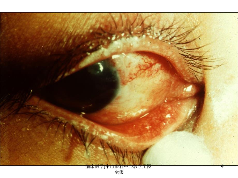 临床医学中山眼科中心教学用图全集课件_第4页
