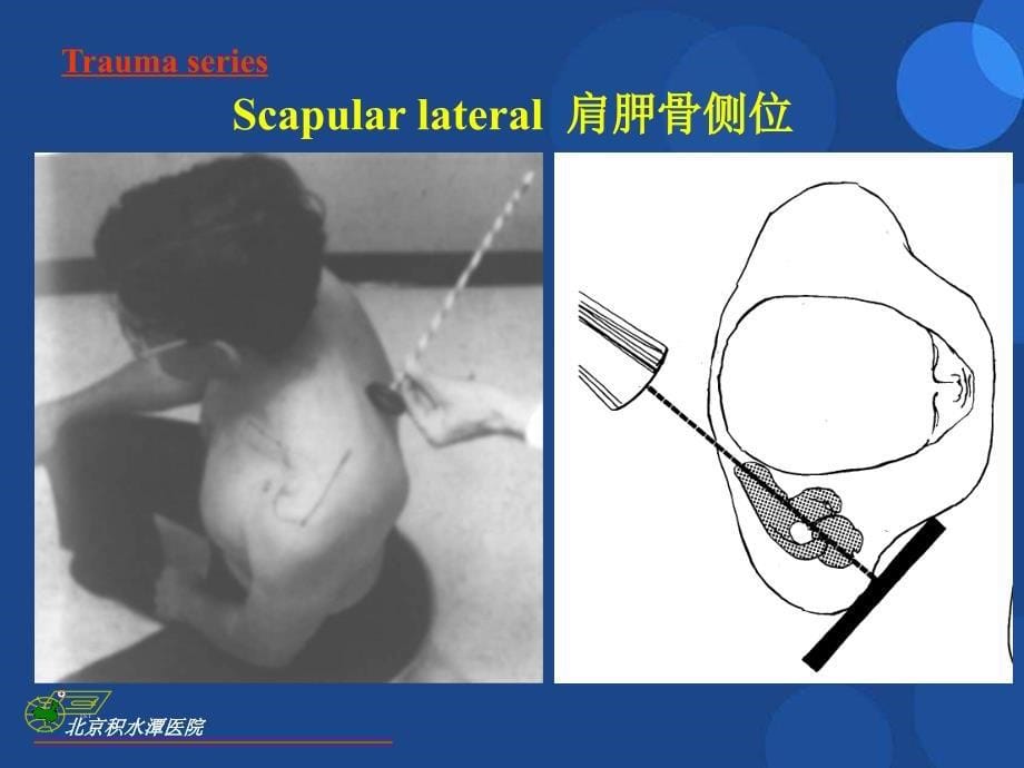 肩关节X线检查的特殊体位投照ppt参考课件_第5页